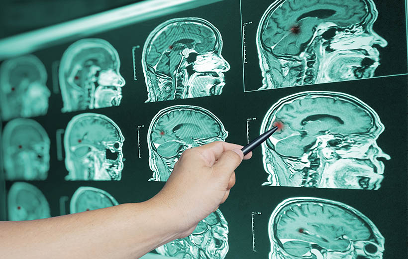 Отек мозга: причины, симптомы, последствия, лечение