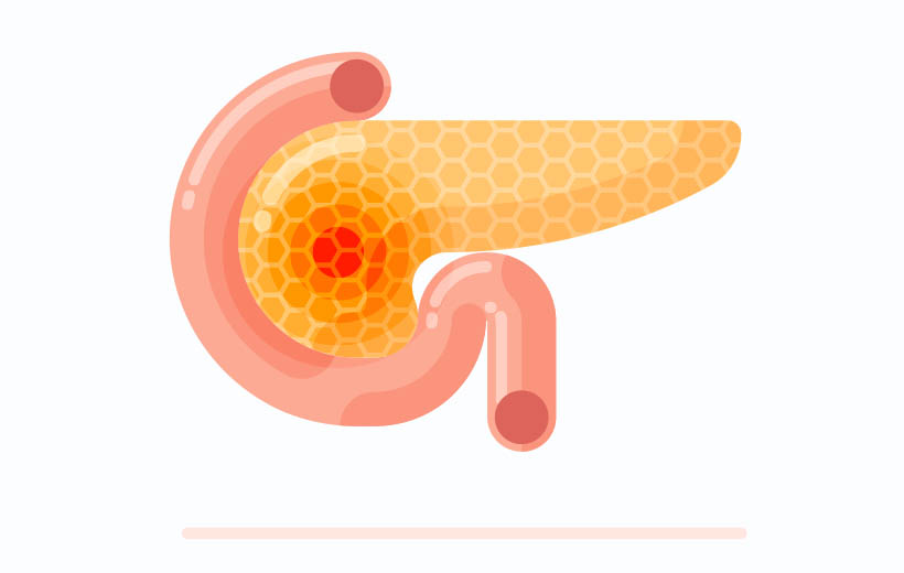 Панкреонекроз: причины, симптомы, лечение