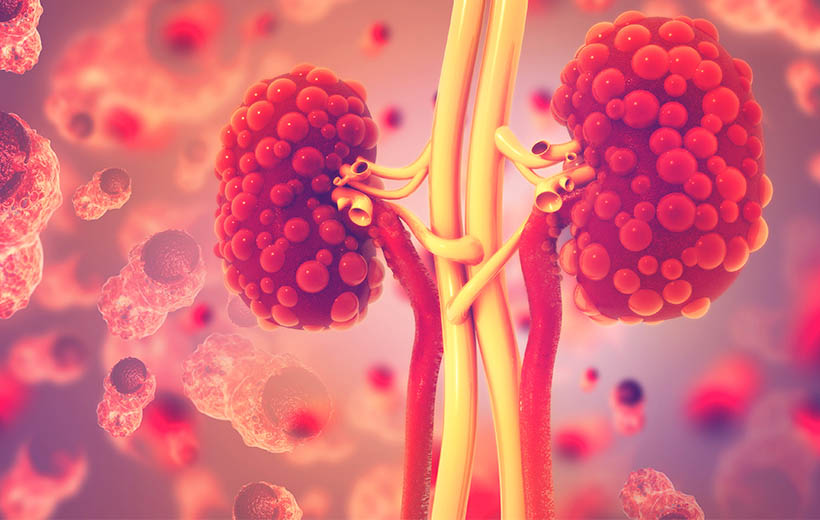 Поликистоз почек: причины, симптомы, лечение, диета
